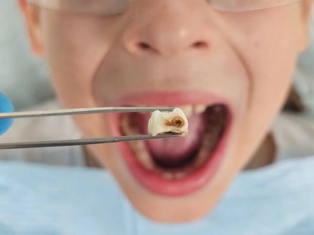 Best Emergency Gum Treatment in Big Lake, TX